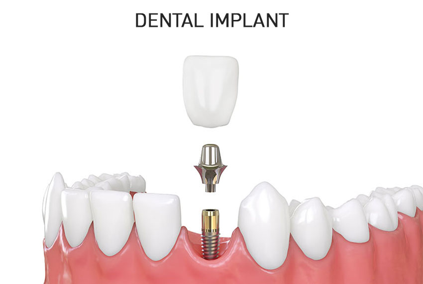 dental implants clinic in Kalol