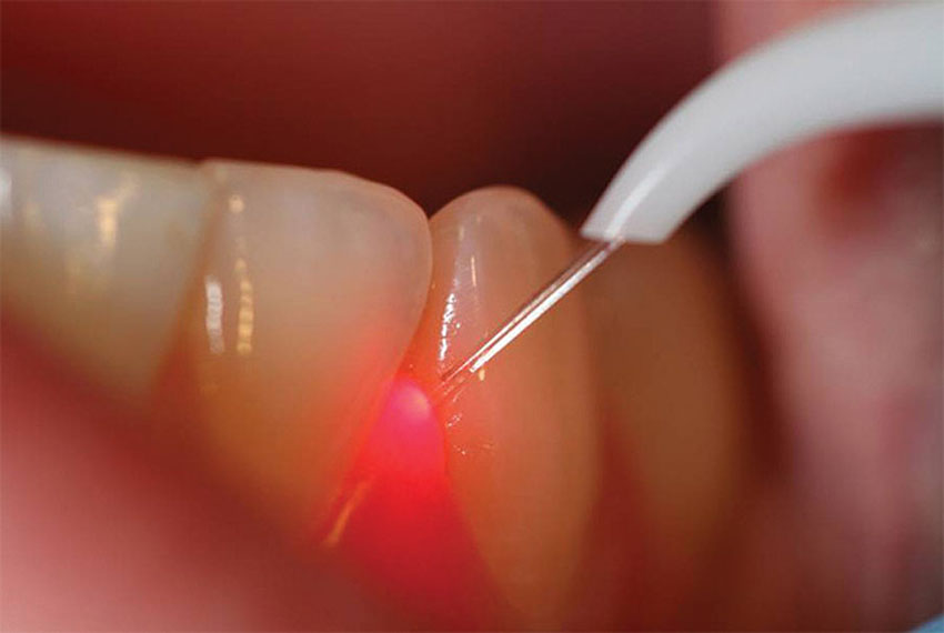 Laser Dentistry in gandhinagar