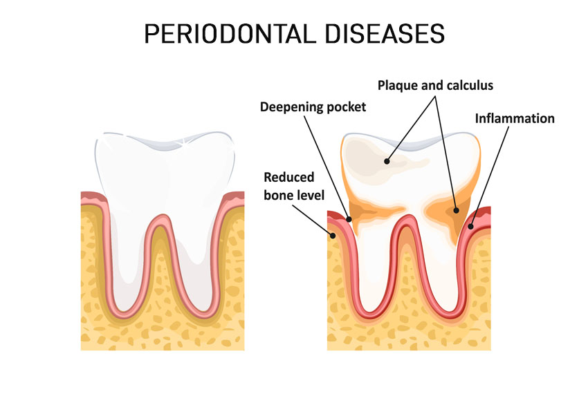 periodontal dentistry treatment in gandhinagar