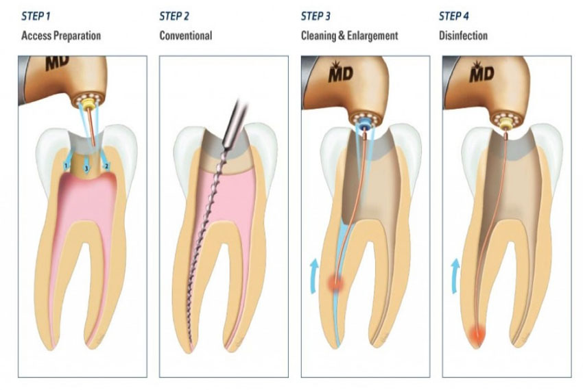 root canal treatment in Kalol