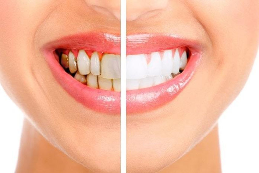 teeth whitening in Kalol